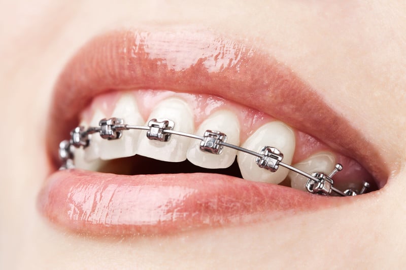 comfort dental braces