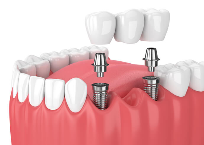 dental Implants East River