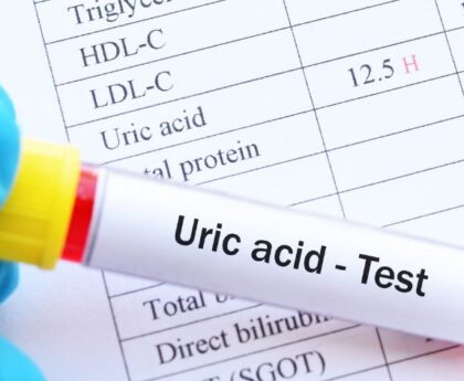 What Should You Need To Know About Uric Acid Blood Test?