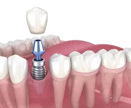 dental implants madeley