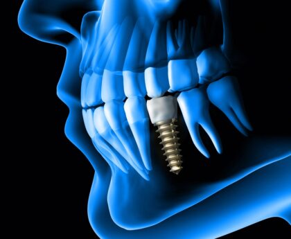 Best Dental Implants Treatment in Dubai